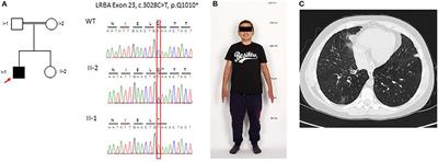 Case Report: Exome Sequencing Reveals LRBA Deficiency in a Patient With End-Stage Renal Disease